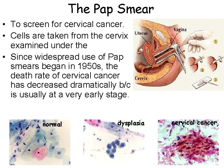 The Pap Smear • To screen for cervical cancer. • Cells are taken from The Pap Smear • To screen for cervical cancer. • Cells are taken from