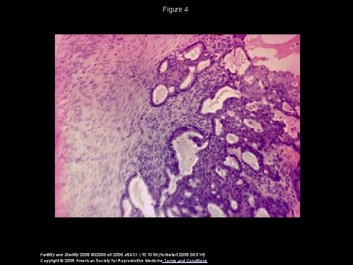 Figure 4 Fertility and Sterility 2008 902006. e 5 -2006. e 8 DOI: (10.