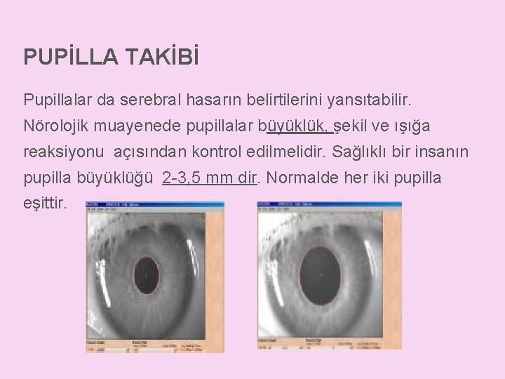 PUPİLLA TAKİBİ Pupillalar da serebral hasarın belirtilerini yansıtabilir. Nörolojik muayenede pupillalar büyüklük, şekil ve