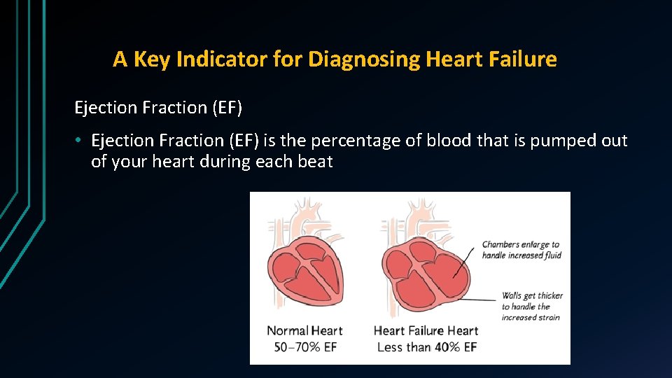 A Key Indicator for Diagnosing Heart Failure Ejection Fraction (EF) • Ejection Fraction (EF)