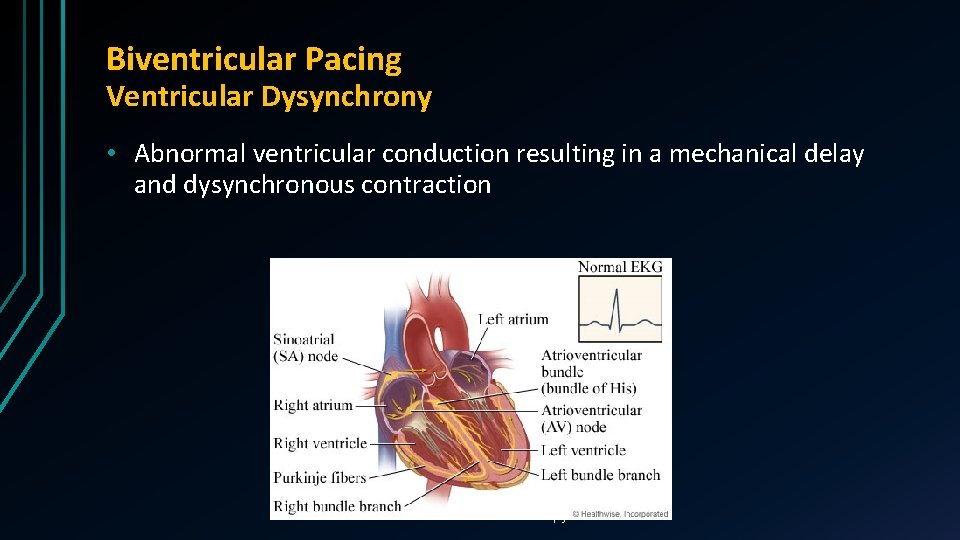 Biventricular Pacing Ventricular Dysynchrony • Abnormal ventricular conduction resulting in a mechanical delay and