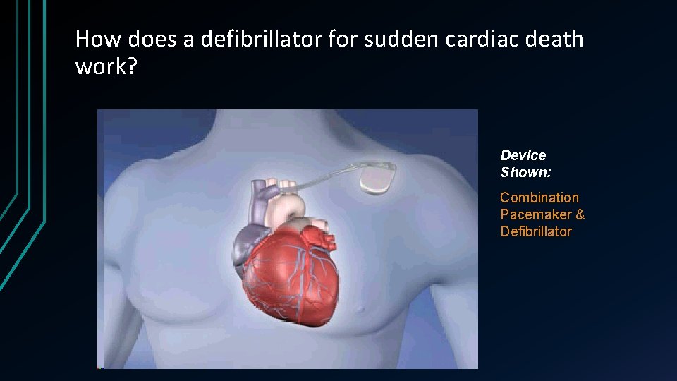 How does a defibrillator for sudden cardiac death work? Device Shown: Combination Pacemaker &