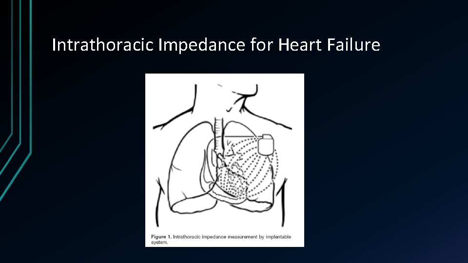 Intrathoracic Impedance for Heart Failure 