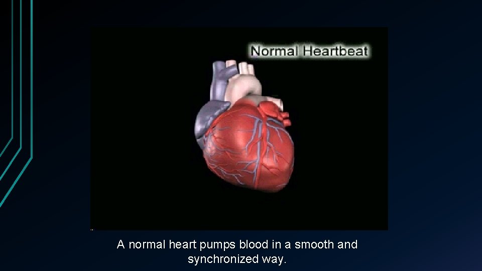 A normal heart pumps blood in a smooth and synchronized way. 