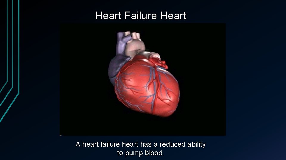 Heart Failure Heart A heart failure heart has a reduced ability to pump blood.