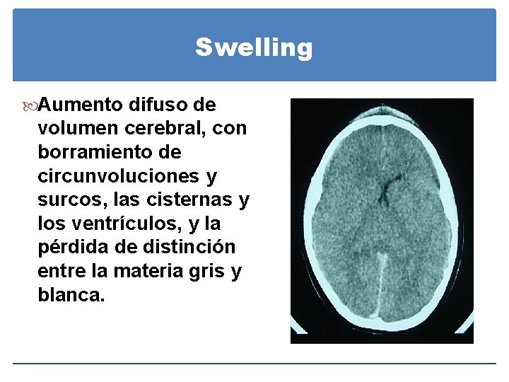 Swelling Aumento difuso de volumen cerebral, con borramiento de circunvoluciones y surcos, las cisternas Swelling Aumento difuso de volumen cerebral, con borramiento de circunvoluciones y surcos, las cisternas