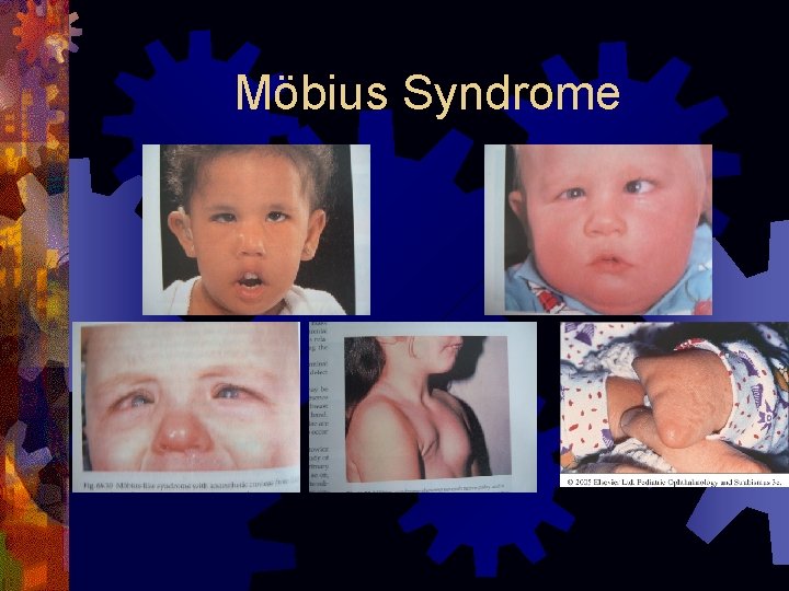 Möbius Syndrome 