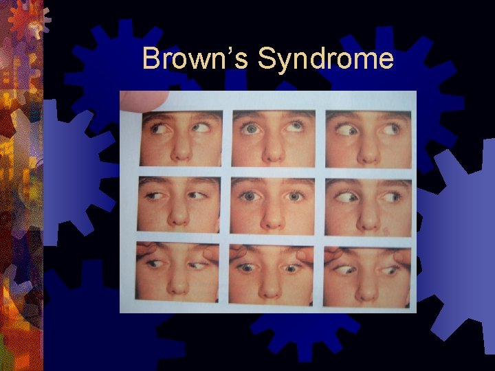 Brown’s Syndrome 