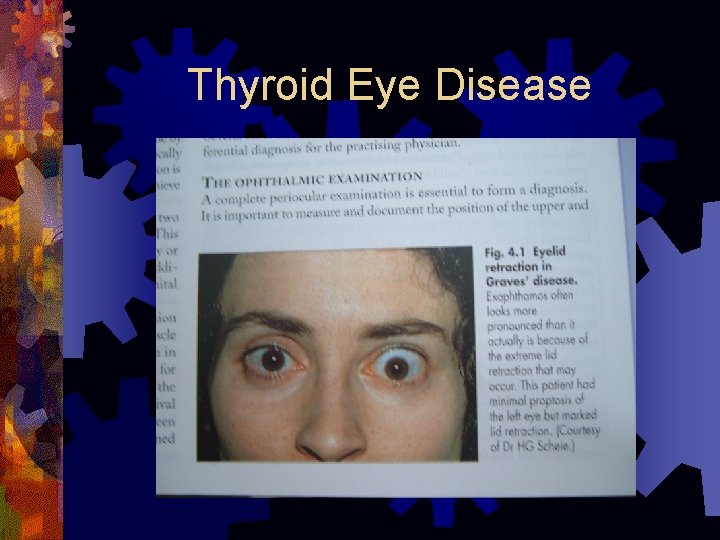 Thyroid Eye Disease 