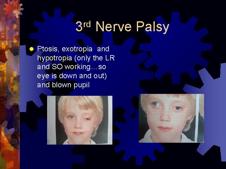 rd 3 ® Nerve Palsy Ptosis, exotropia and hypotropia (only the LR and SO