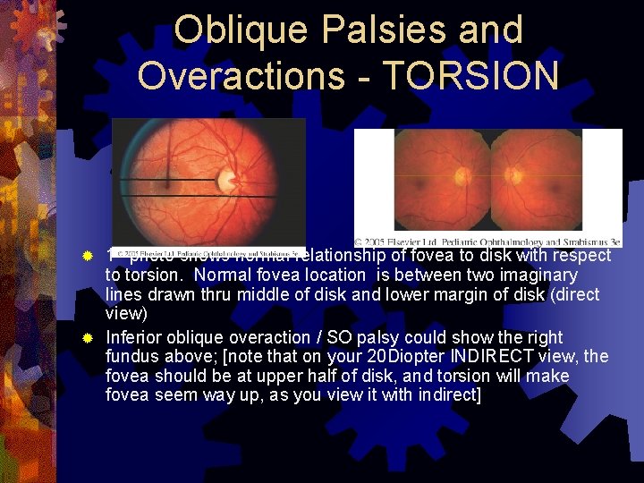 Oblique Palsies and Overactions - TORSION 1 st photo shows normal relationship of fovea