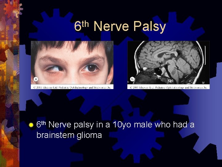 th 6 ® 6 th Nerve Palsy Nerve palsy in a 10 yo male