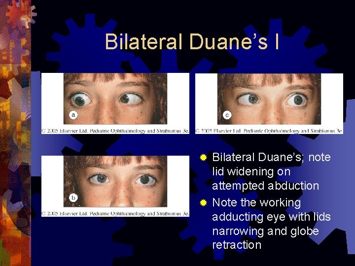 Bilateral Duane’s I Bilateral Duane’s; note lid widening on attempted abduction ® Note the