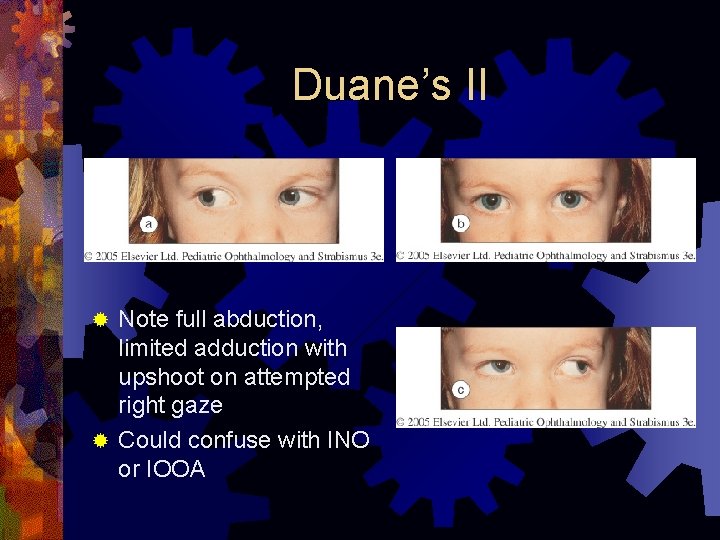 Duane’s II Note full abduction, limited adduction with upshoot on attempted right gaze ®