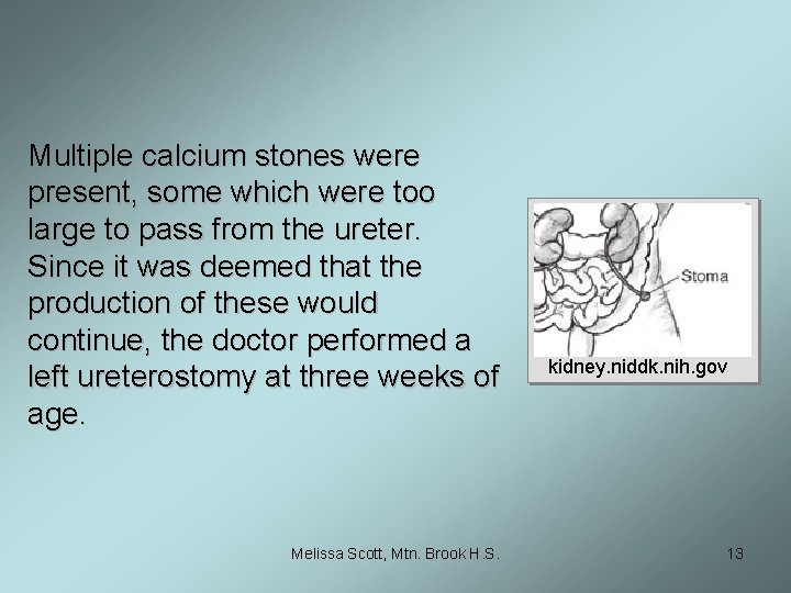 Multiple calcium stones were present, some which were too large to pass from the