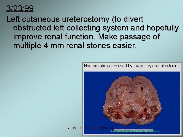 3/23/99 Left cutaneous ureterostomy (to divert obstructed left collecting system and hopefully improve renal