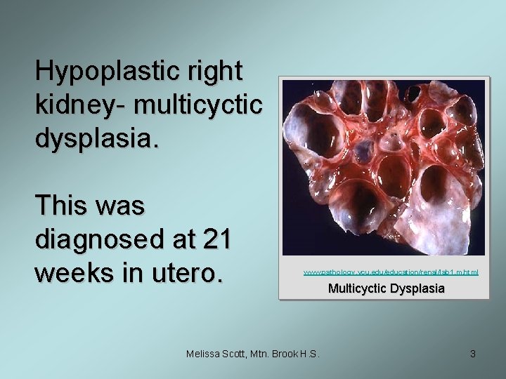 Hypoplastic right kidney- multicyctic dysplasia. This was diagnosed at 21 weeks in utero. www.