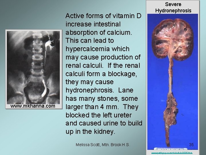 www. mkhanna. com Active forms of vitamin D increase intestinal absorption of calcium. This