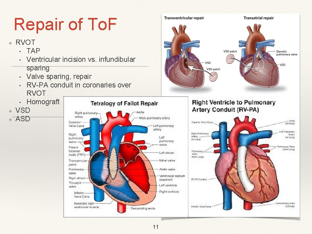 Repair of To. F ❖ ❖ ❖ RVOT • TAP • Ventricular incision vs.