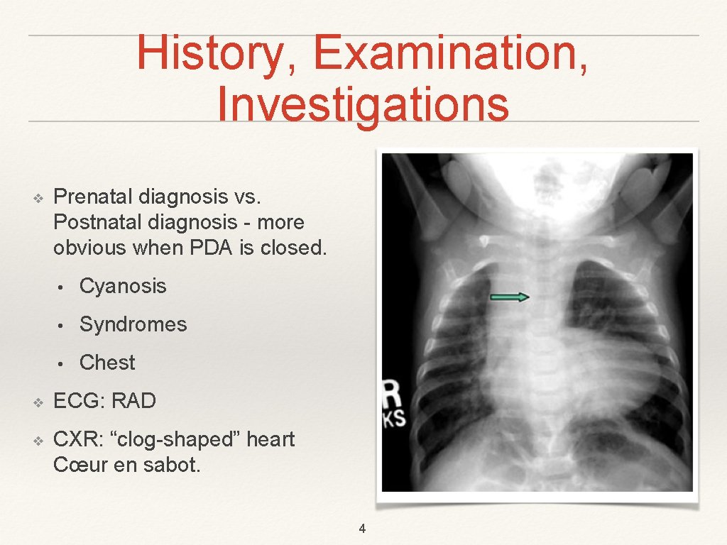 History, Examination, Investigations ❖ Prenatal diagnosis vs. Postnatal diagnosis - more obvious when PDA