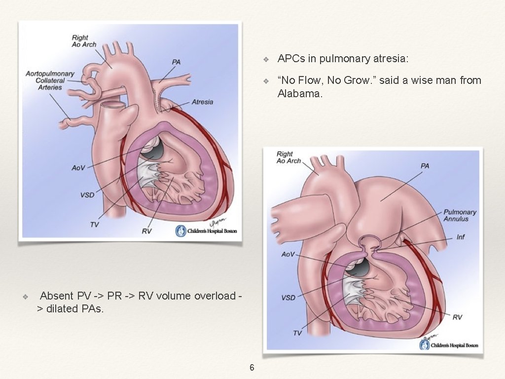 ❖ Absent PV -> PR -> RV volume overload > dilated PAs. 6 ❖