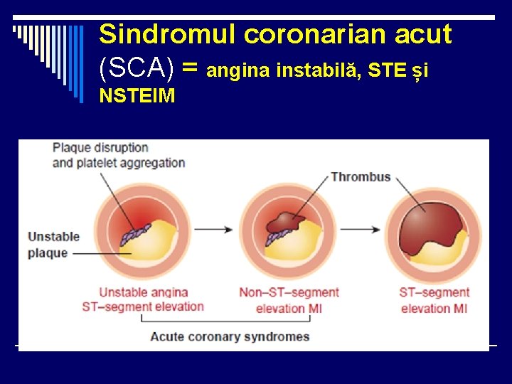 Sindromul coronarian acut (SCA) = angina instabilă, STE și NSTEIM Sindromul coronarian acut (SCA) = angina instabilă, STE și NSTEIM