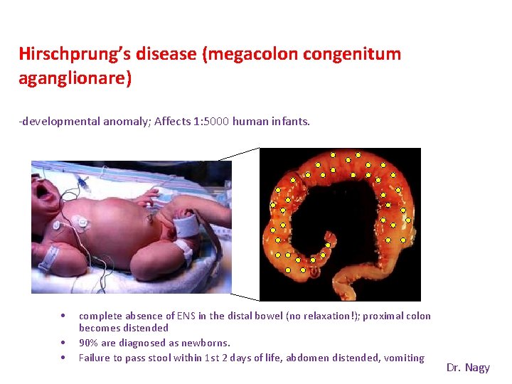 Hirschprung’s disease (megacolon congenitum aganglionare) -developmental anomaly; Affects 1: 5000 human infants. • •