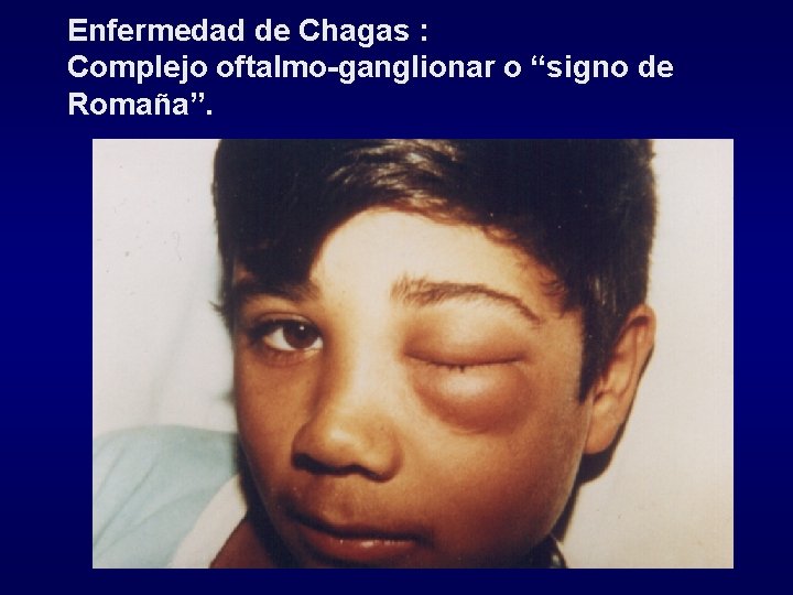 Enfermedad de Chagas : Complejo oftalmo-ganglionar o “signo de Romaña”. 