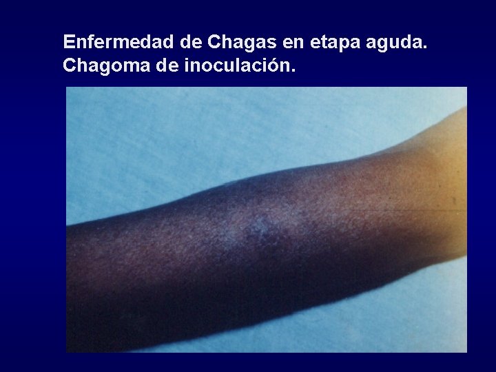 Enfermedad de Chagas en etapa aguda. Chagoma de inoculación. 