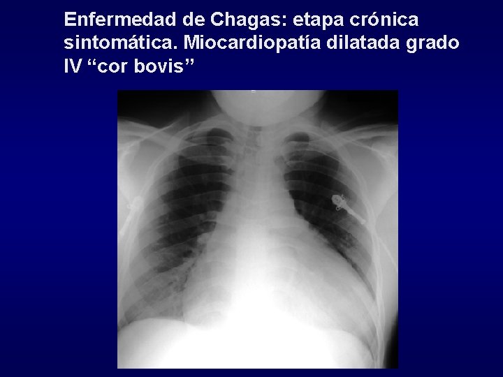 Enfermedad de Chagas: etapa crónica sintomática. Miocardiopatía dilatada grado IV “cor bovis” 