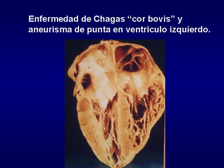 Enfermedad de Chagas “cor bovis” y aneurisma de punta en ventrículo izquierdo. 