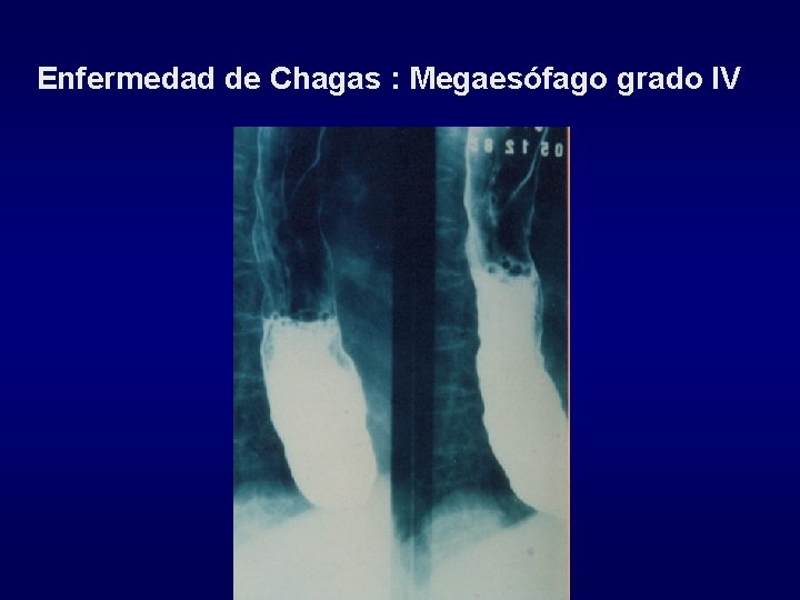 Enfermedad de Chagas : Megaesófago grado IV 