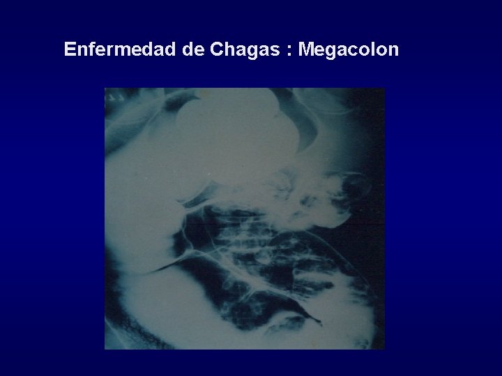 Enfermedad de Chagas : Megacolon 