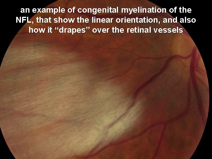 an example of congenital myelination of the NFL, that show the linear orientation, and