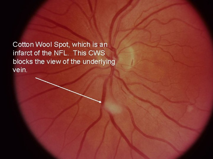 Cotton Wool Spot, which is an infarct of the NFL. This CWS blocks the