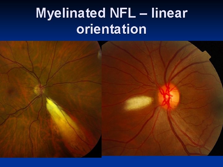 Myelinated NFL – linear orientation 