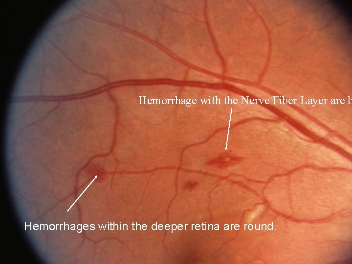 Hemorrhage with the Nerve Fiber Layer are li Hemorrhages within the deeper retina are
