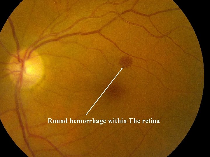 Round hemorrhage within The retina 
