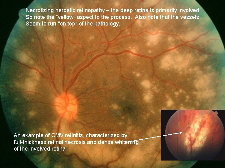 Necrotizing herpetic retinopathy – the deep retina is primarily involved, So note the “yellow”