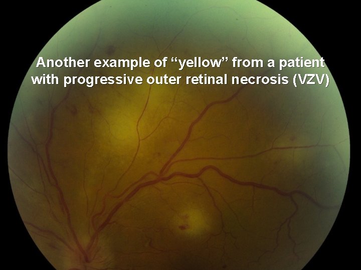 Another example of “yellow” from a patient with progressive outer retinal necrosis (VZV) 