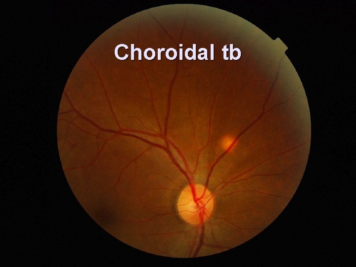 Choroidal tb 