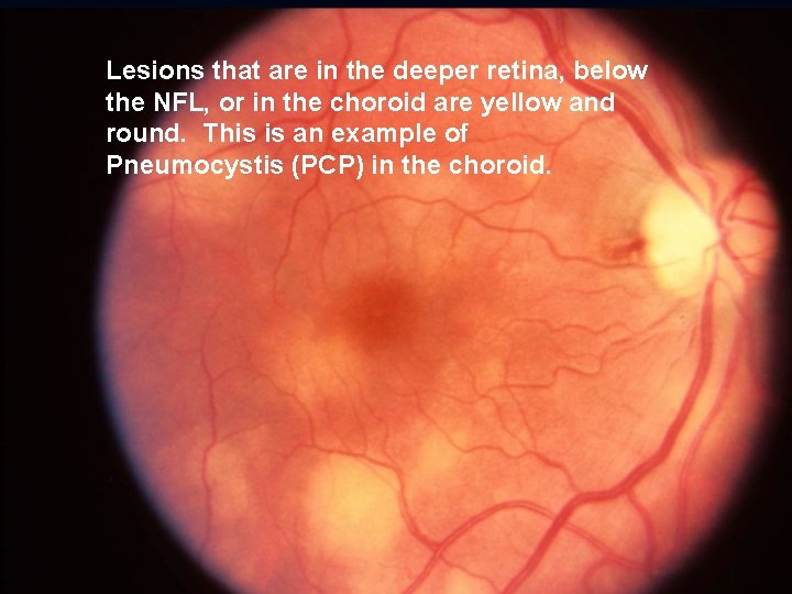Lesions that are in the deeper retina, below the NFL, or in the choroid