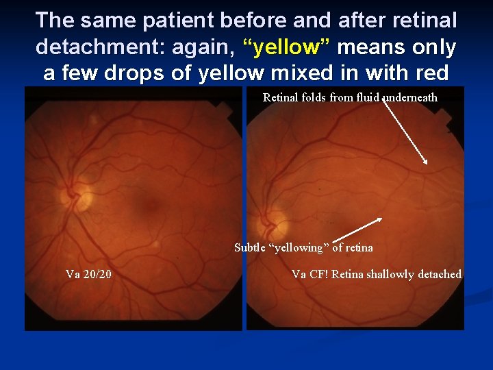 The same patient before and after retinal detachment: again, “yellow” means only a few