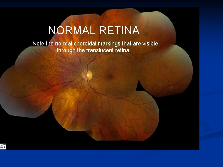 NORMAL RETINA Note the normal choroidal markings that are visible through the translucent retina.