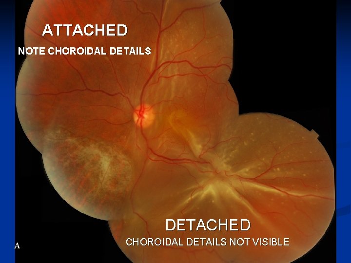 ATTACHED NOTE CHOROIDAL DETAILS DETACHED A CHOROIDAL DETAILS NOT VISIBLE 