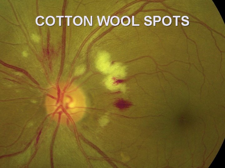 COTTON WOOL SPOTS 