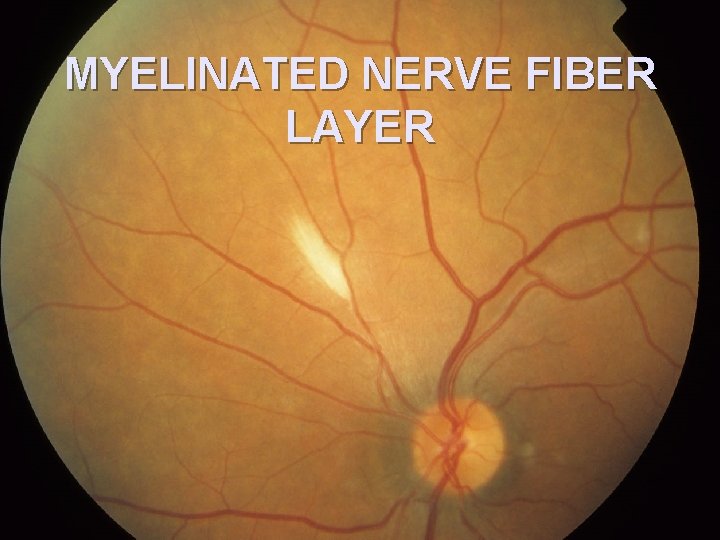 MYELINATED NERVE FIBER LAYER 