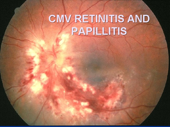 CMV RETINITIS AND PAPILLITIS 