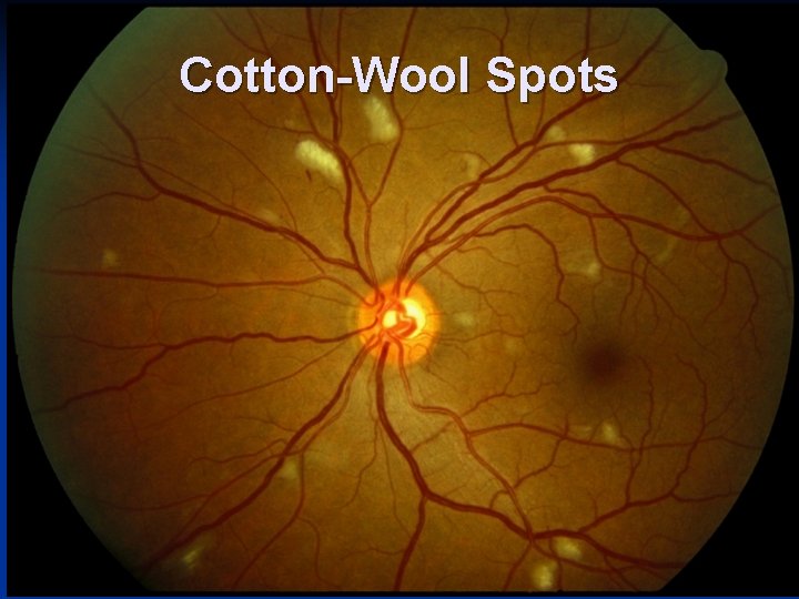 Cotton-Wool Spots 