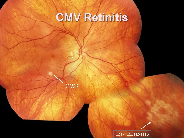 CMV Retinitis CWS CMV RETINITIS 